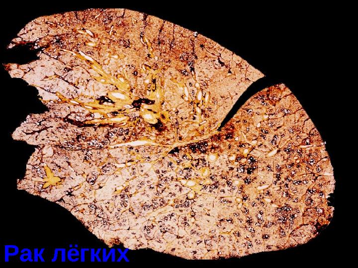 Рак лёгкихРак лёгких