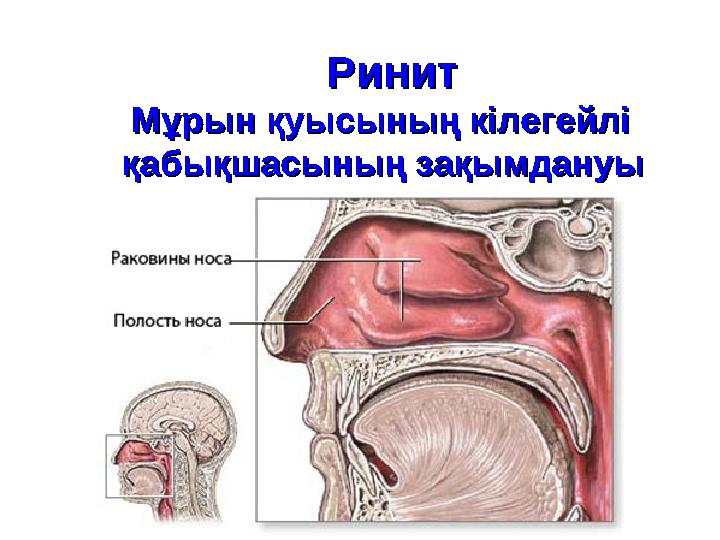 РинитРинит Мұрын қуысының кілегейліМұрын қуысының кілегейлі қабықшасын