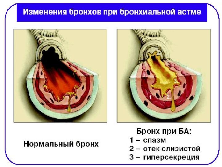 АнгинаАнгина