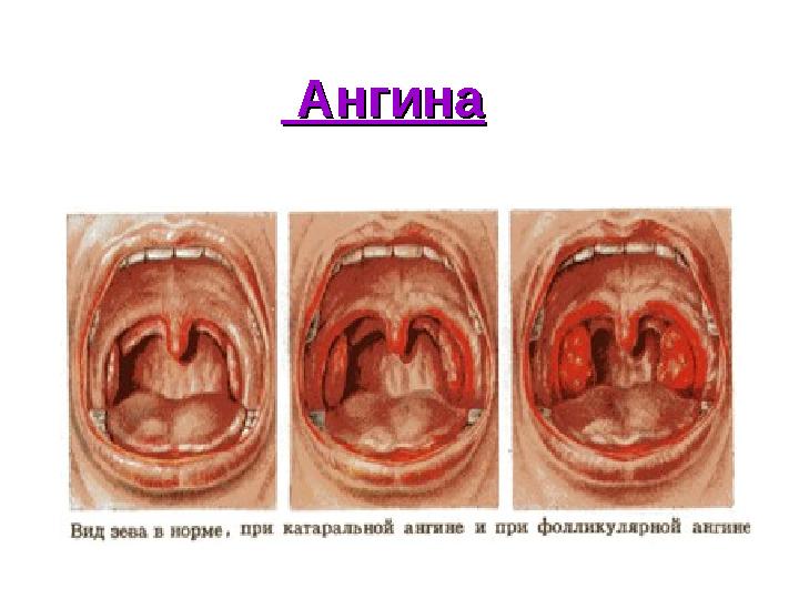 АнгинаАнгина