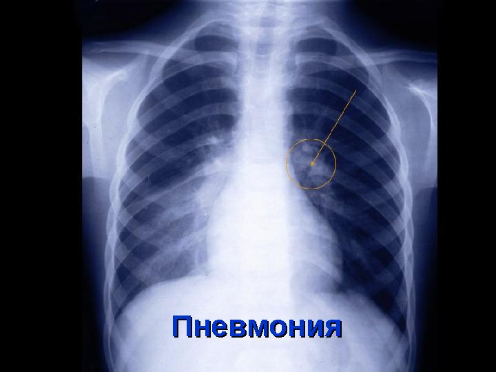 ПневмонияПневмония