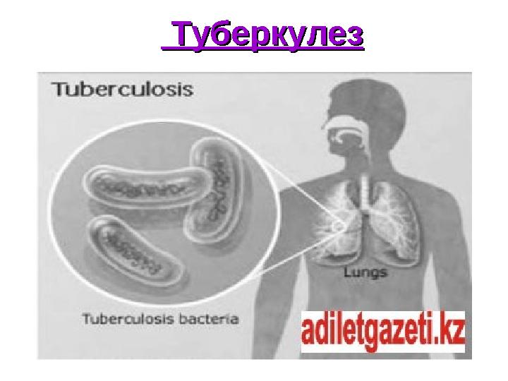 ТуберкулезТуберкулез
