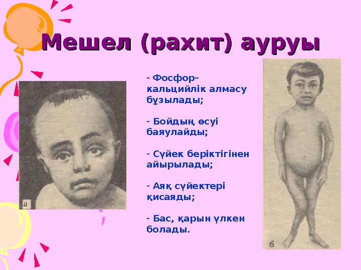 Мешел (рахит) ауруыМешел (рахит) ауруы - Фосфор– кальцийлік алмасу бұзылады; - Бойдың өсуі баяулайды; - Сүйек беріктігінен