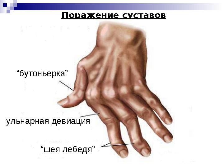 Поражение суставов “бутоньерка” ульнарная девиация “шея лебедя”