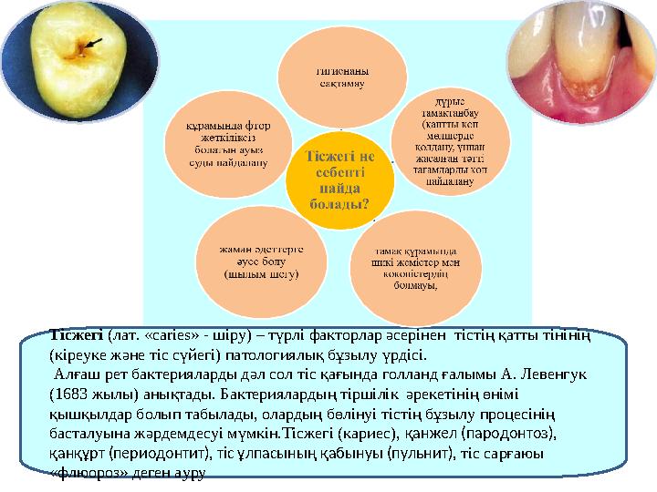 Тісжегі (лат. «caries» - шіру) – түрлі факторлар әсерінен тістің қатты тінінің (кіреуке және тіс сүйегі) патологиялық бұзылу ү