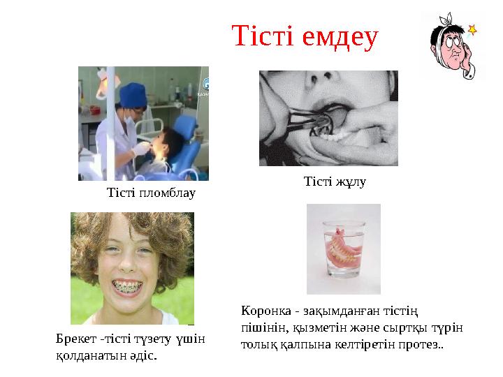 Тісті емдеу Тісті пломблау Тісті жұлу Коронка - зақымданған тістің пішінін, қызметін және сыртқы түрін толық қал