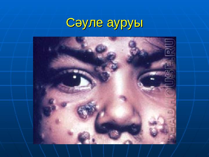 Сәуле ауруыСәуле ауруы