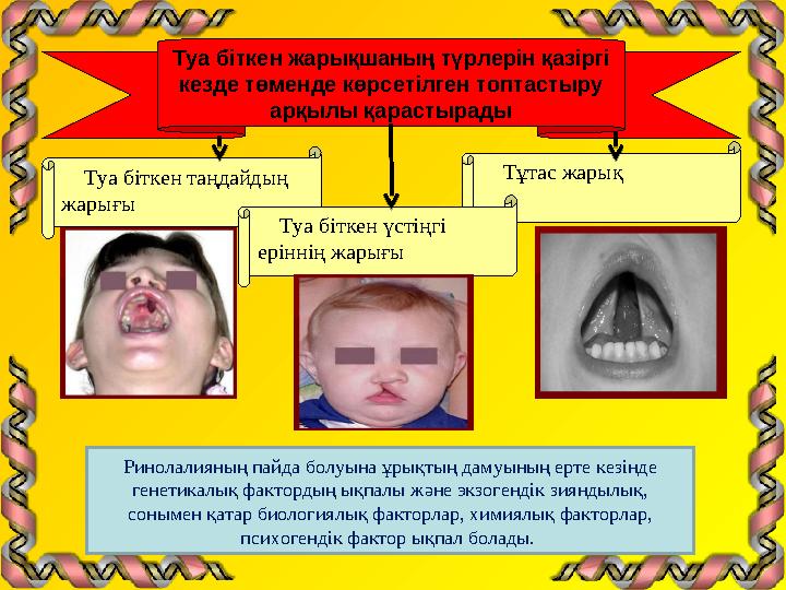 Туа біткен жарықшаның түрлерін қазіргі кезде төменде көрсетілген топтастыру арқылы қарастырады Туа біткен таңдайдың жарығ