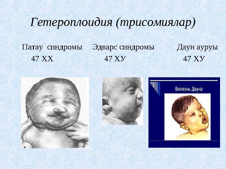 Гетероплоидия (трисомиялар) Патау синдромы Эдварс синдромы Даун ауруы 47 ХХ