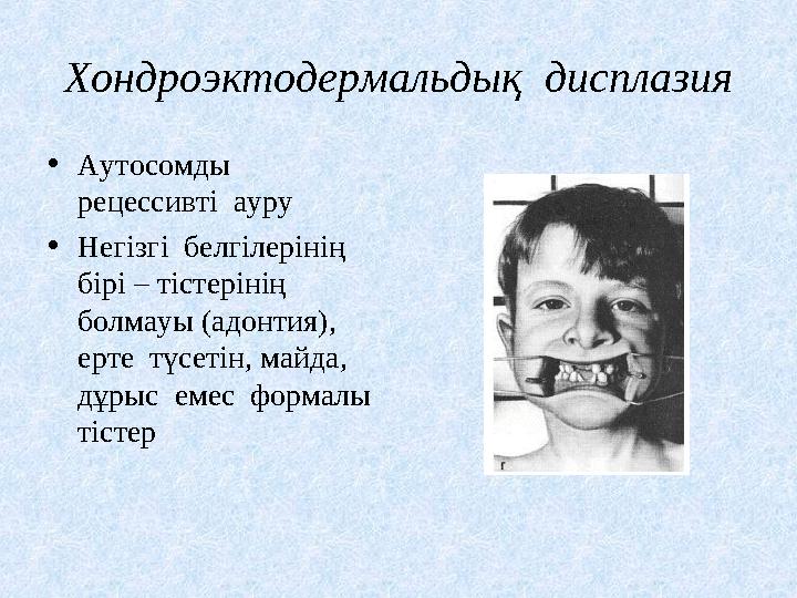 Хондроэктодермальдық дисплазия •Аутосомды рецессивті ауру •Негізгі белгілерінің бірі – тістерінің болмауы (адонтия),
