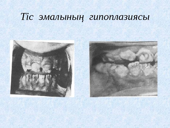 Тіс эмалының гипоплазиясы