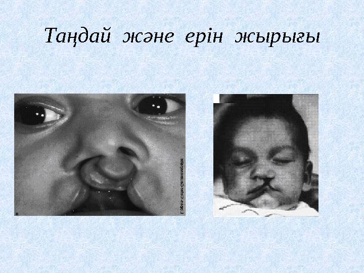 Таңдай және ерін жырығы