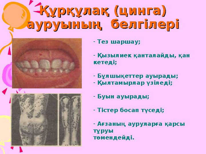 Құрқұлақ (цинга) Құрқұлақ (цинга) ауруының белгілеріауруының белгілері - Тез шаршау; - Қызылиек қанталайды, қан кетеді; -