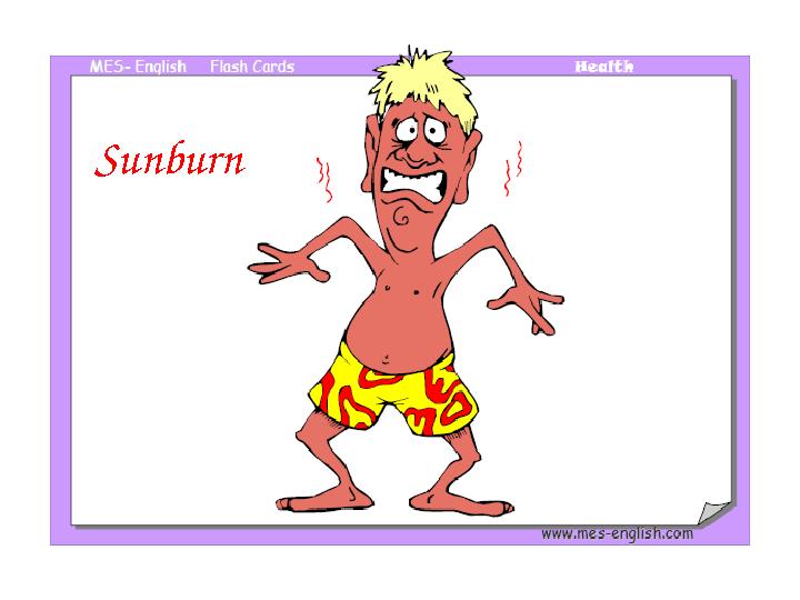 Sunburn