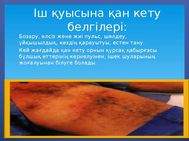 Іш қуысына қан кету белгілері: Бозару, әлсіз және жиі пульс, шөлдеу, ұйқышылдық, көздің қарауытуы, естен тану. Кей жағдайда қа