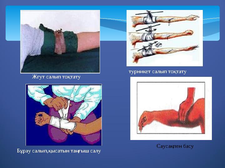Жгут салып то қ тату турникет салып тоқтату Б ұ рау салып, қысатын таңғыш салу Саусақпен басу