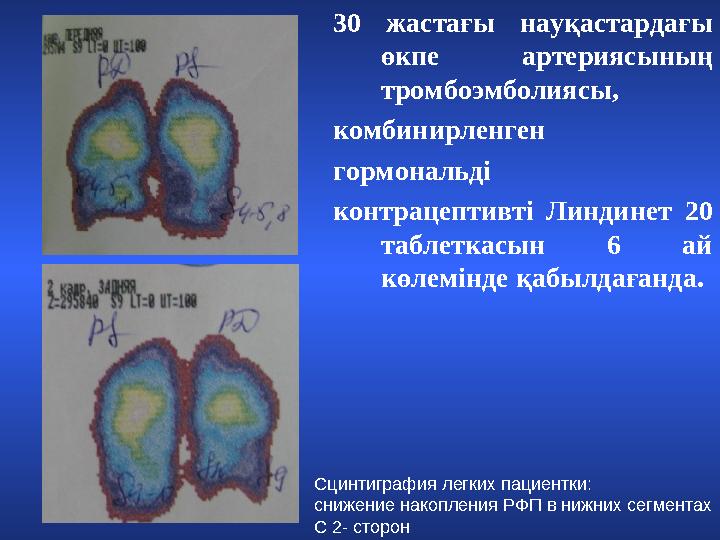 30 жастағы науқастардағы өкпе артериясының тромбоэмболиясы, комбинирленген гормональді контрацептивті Линдинет 20 таб