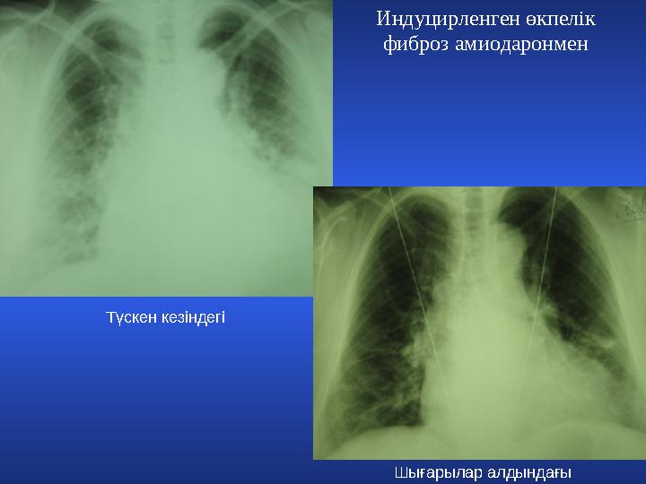 Индуцирленген өкпелік фиброз амиодаронмен Түскен кезіндегі Шығарылар алдындағы