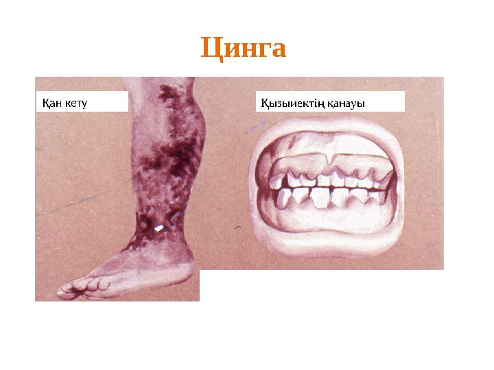 Цинга Қан кету Қызыиектің қанауы Қан кету