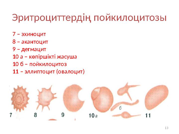 Эритроциттердің пойкилоцитозы 7 – эхиноцит 8 – акантоцит 9 – дегмацит 10 а – көпіршікті жасуша 10 б – пойкилоцитоз 11 – эллиптоц