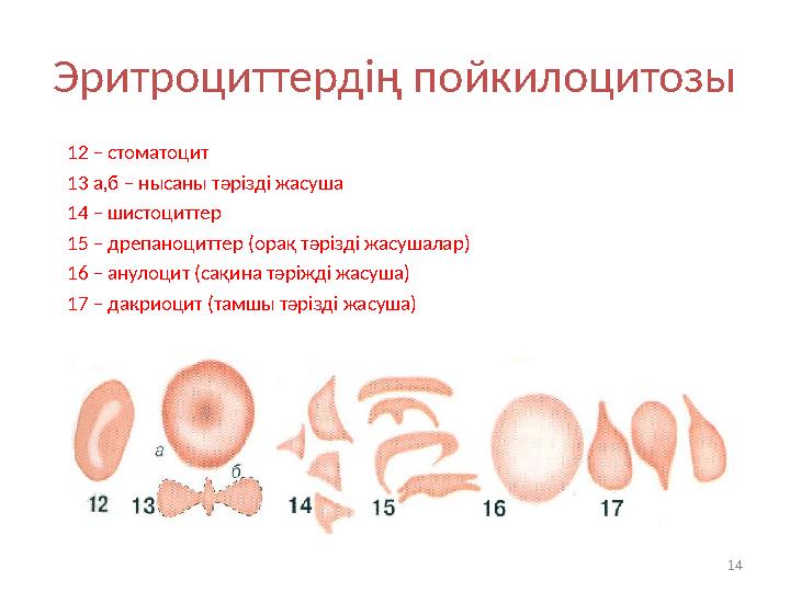 Эритроциттердің пойкилоцитозы 12 – стоматоцит 13 а,б – нысаны тәрізді жасуша 14 – шистоциттер 15 – дрепаноциттер (орақ тәрізді ж