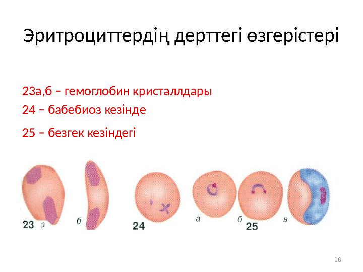 Эритроциттердің дерттегі өзгерістері 23а,б – гемоглобин кристаллдары 24 – бабебиоз кезінде 25 – безгек кезіндегі 16