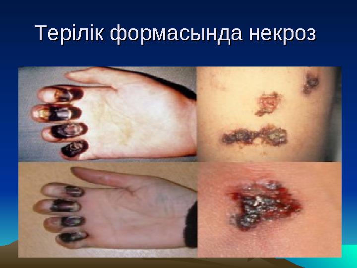 Терілік формасында некроз Терілік формасында некроз