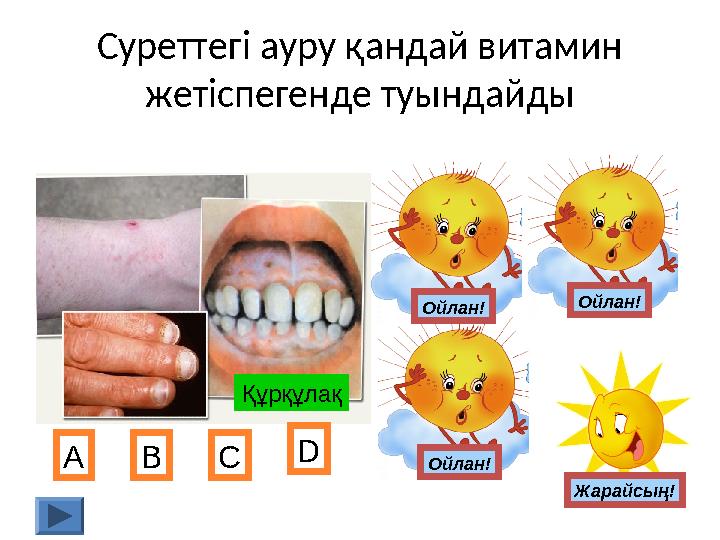 Суреттегі ауру қандай витамин жетіспегенде туындайды Құрқұлақ А В С D Жарайсың!Ойлан!Ойлан! Ойлан!