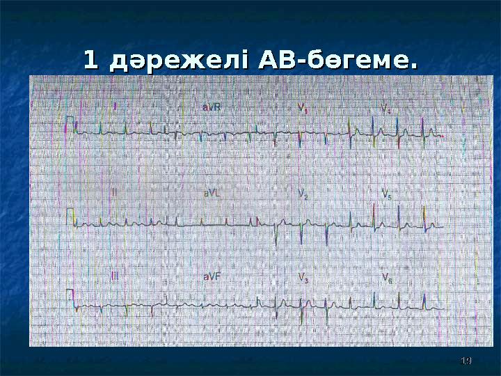 19191 1 дәрежелі дәрежелі АВ-бөгеме.АВ-бөгеме.