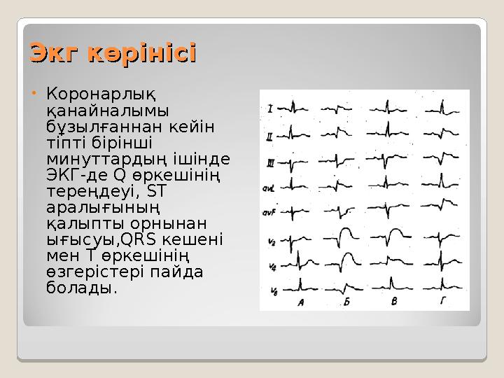 Экг көрінісіЭкг көрінісі • Коронарлық қанайналымы бұзылғаннан кейін тіпті бірінші минуттардың ішінде ЭКГ-де Q өркешінің