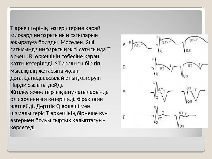 T өркештерінің өзгерістеріне қарай миокард инфарктының сатыларын ажыратуға болады. Мәселен, 2ші сатысында инфарктың жіті са