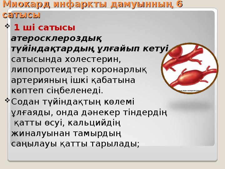 Миокард инфаркты дамуынның 6 Миокард инфаркты дамуынның 6 сатысысатысы  1 ші сатысы атеросклероздық түйіндақтардың ұлғай