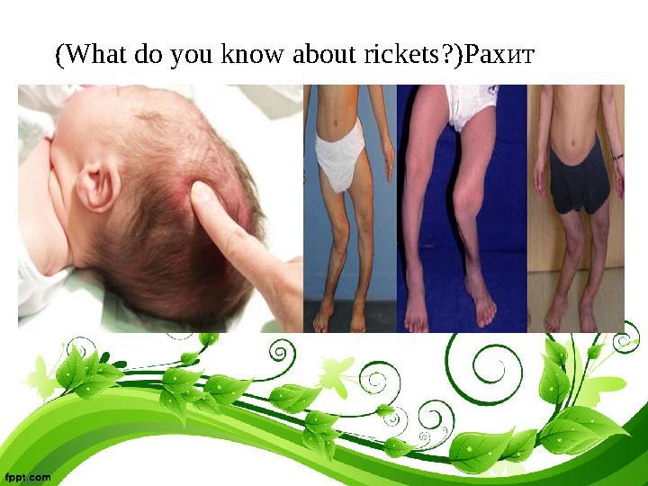 (What do you know about rickets?)Рахит