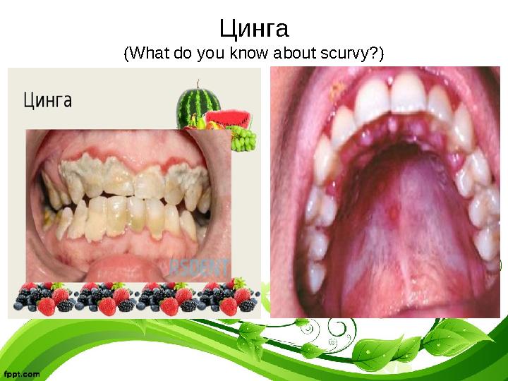 Цинга (What do you know about scurvy?)