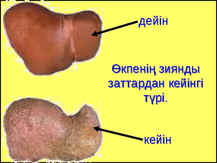 Өкпенің зиянды заттардан кейінгі түрі. Өкпенің зиянды заттардан кейінгі түрі. кейінкейін дейіндейін