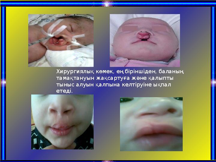 Хирургиялық көмек, ең біріншіден, баланың тамақтануын жақсартуға және қалыпты тыныс алуын қалпына келтіруіне ықпал етеді.