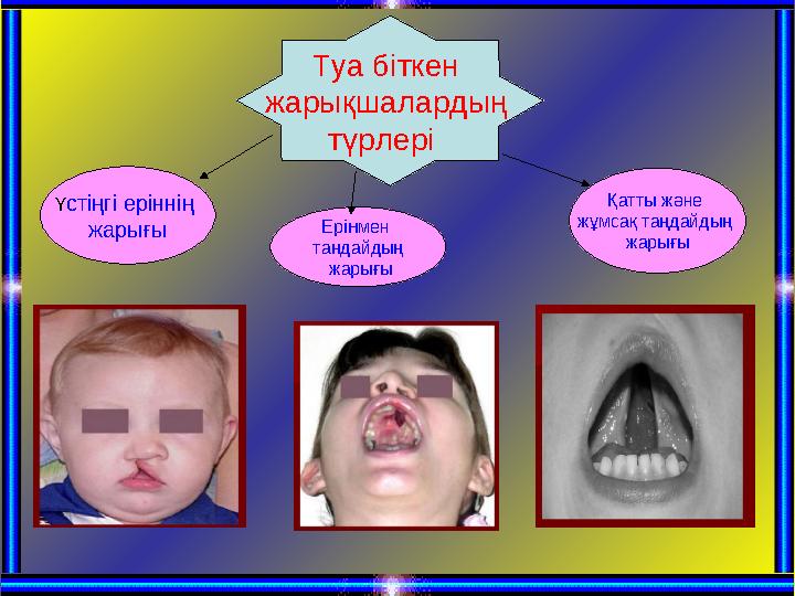 Туа біткен жарықшалардың түрлері Үстіңгі еріннің жарығы Қатты және жұмсақ таңдайдың жарығы Ерінмен таңдайдың жарығы