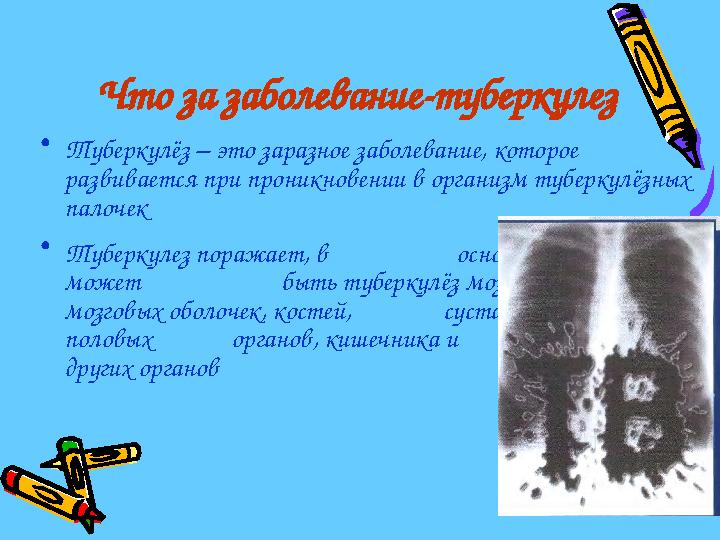 Что за заболевание-туберкулез •Туберкулёз – это заразное заболевание, которое развивается при проникновении в организм тубер