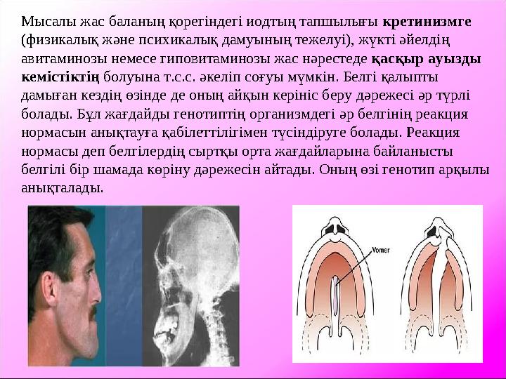 Мысалы жас баланың қорегіндегі иодтың тапшылығы кретинизмге (физикалық және психикалық дамуының тежелуі), жүкті әйелдің авитам