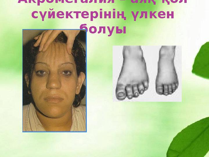 Акромегалия – аяқ-қол сүйектерінің үлкен болуы
