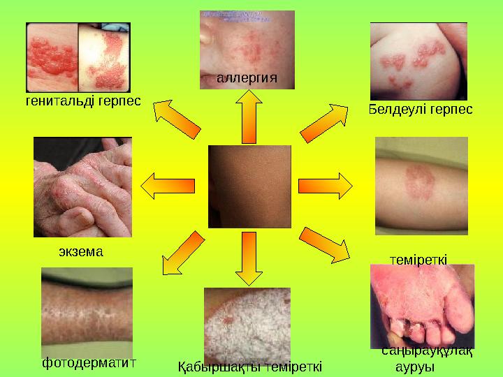 аллергия Белдеулі герпес теміреткі саңырауқұлақ ауруыҚабыршақты теміреткі генитальді герпес фотодерматит экзема