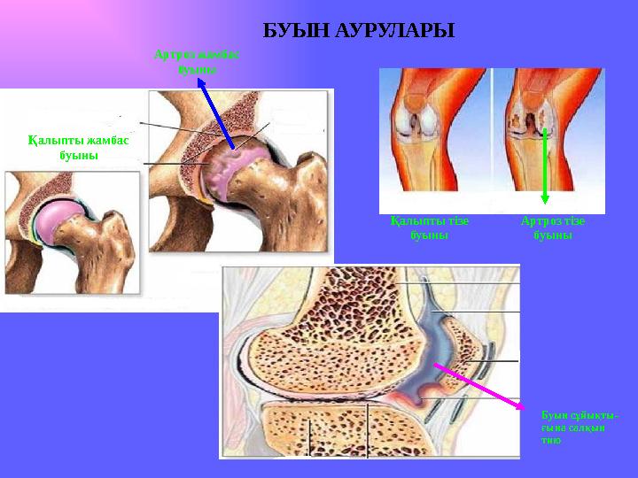 БУЫН АУ РУЛАРЫ Қалыпты жамбас буыны Артроз жамбас буыны Қалыпты тізе буыны Артроз тізе буыны Буын сұйықты- ғына салқын тию