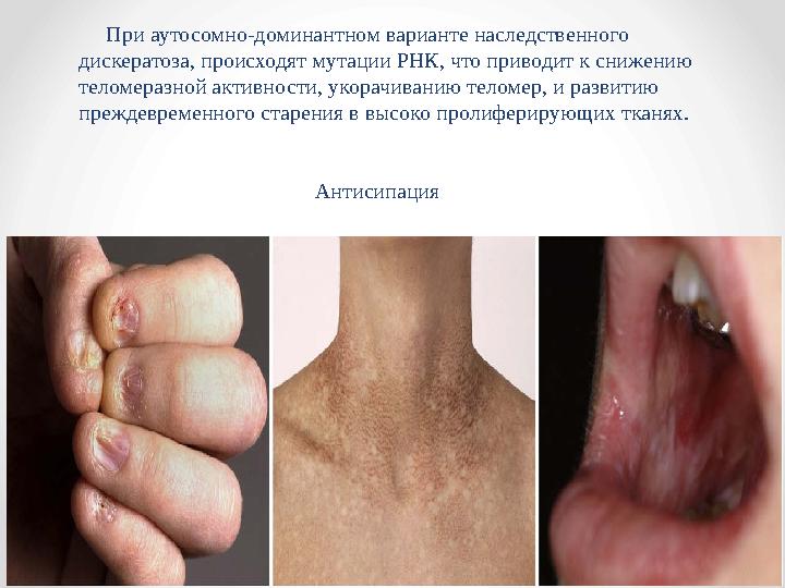 При аутосомно-доминантном варианте наследственного дискератоза, происходят мутации РНК, что приводит к снижению теломера