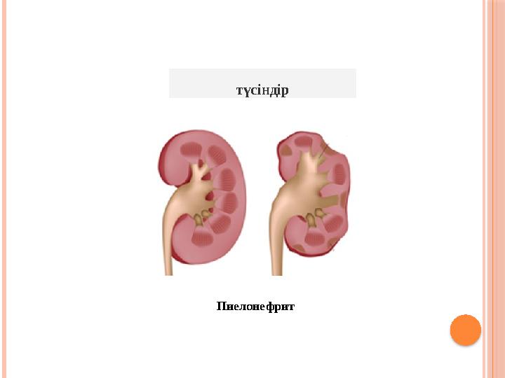 түсіндір Пиелонефрит