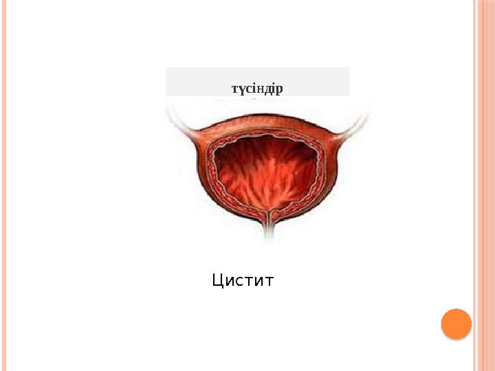 түсіндір Цистит