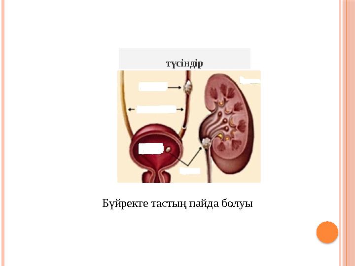 түсіндір Бүйректе тастың пайда болуы