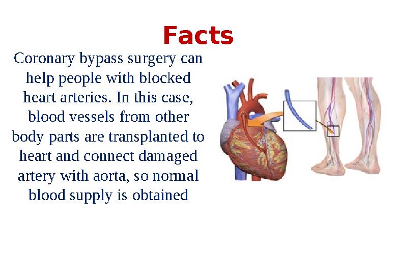 Facts Coronary bypass surgery can help people with blocked heart arteries. In this case, blood vessels from other body parts