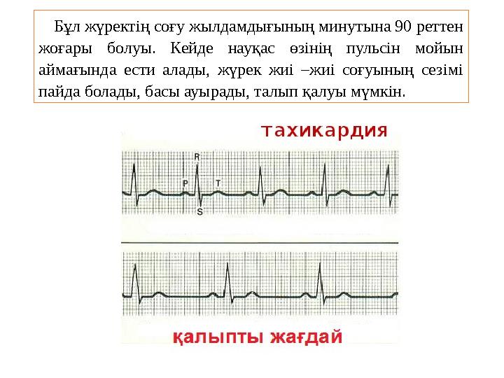 Бұл жүректің соғу жылдамдығының минутына 90 реттен жоғары болуы. Кейде науқас өзінің пульсін мойын аймағында ести алады, жүрек