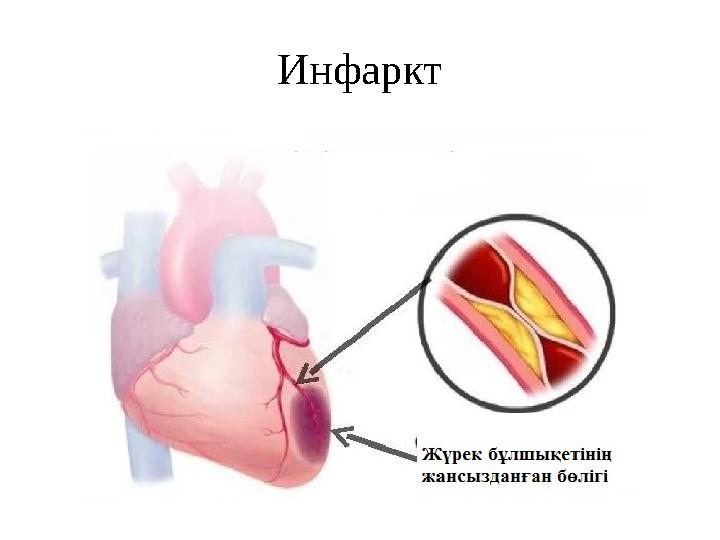 Инфаркт