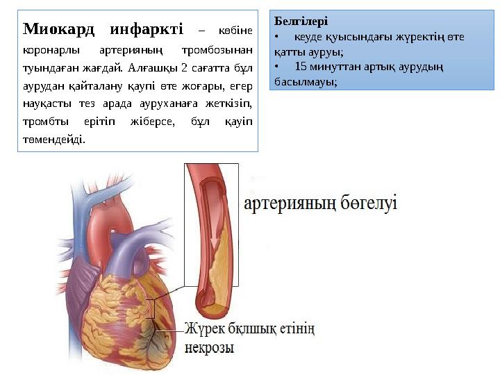 Миокард инфаркті – көбіне коронарлы артерияның тромбозынан туындаған жағдай. Алғашқы 2 сағатта бұл аурудан қайталану қаупі өт